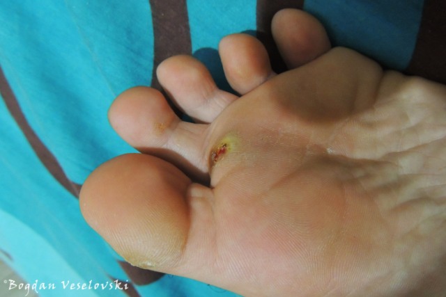 Tungiasis caused by nigua, smallest flea in the world (jigger flea. Tunga penetrans)